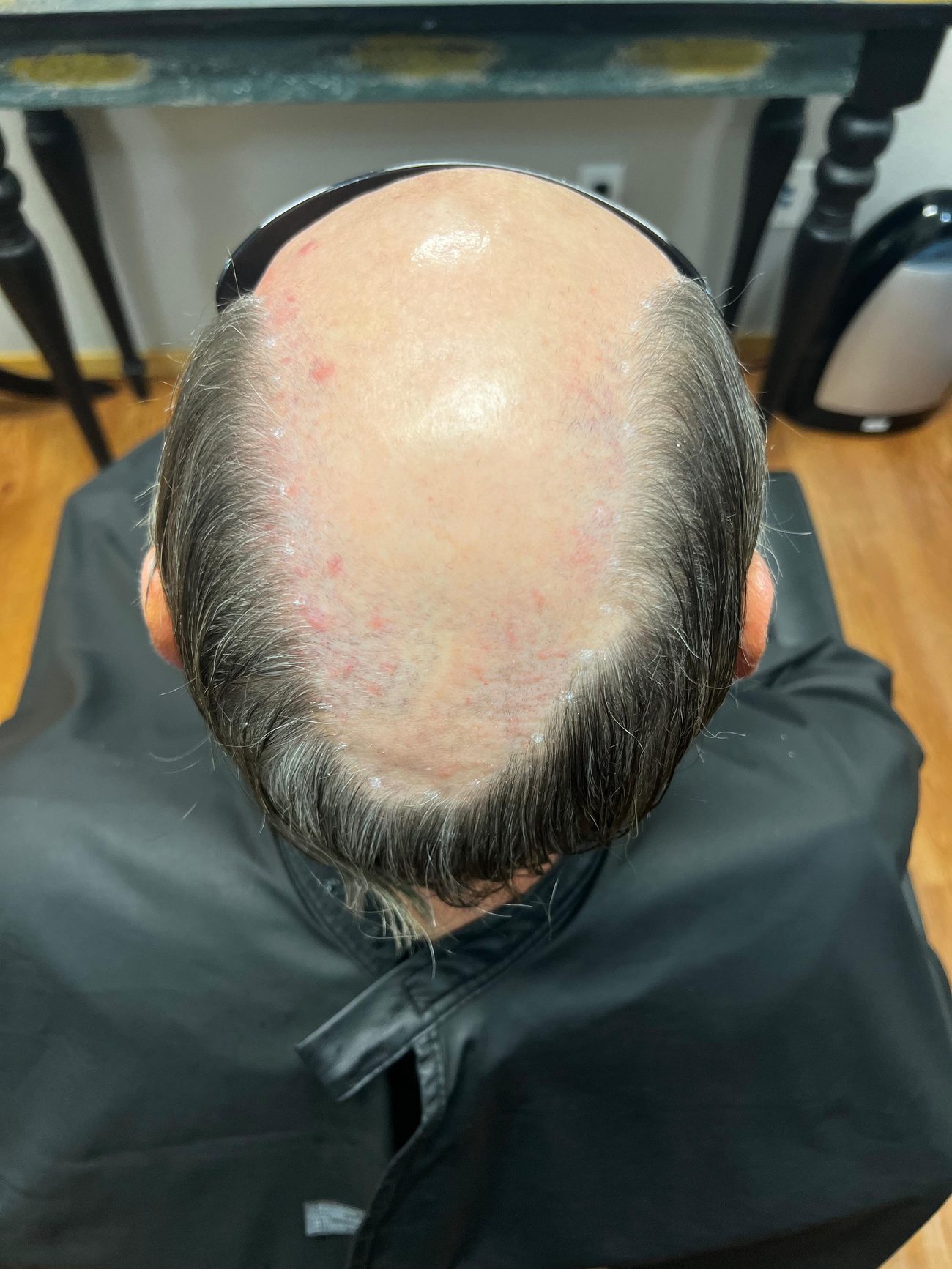 A man’s exposed crown photographed from above before hair replacement