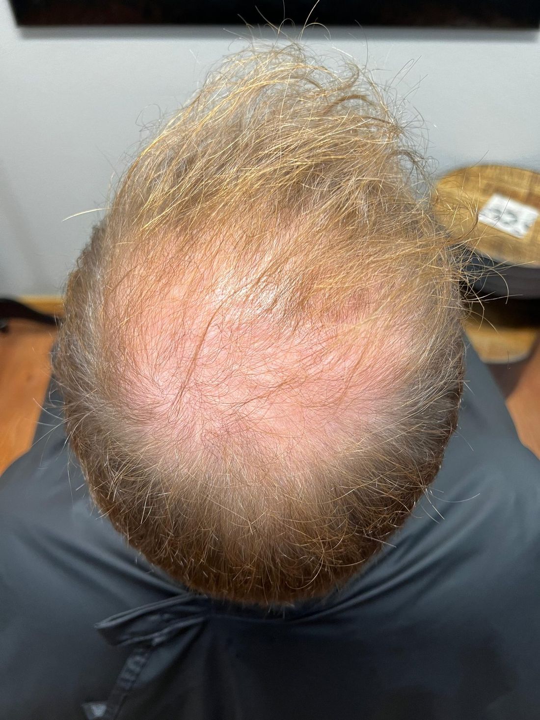 Diffuse thinning across the crown photographed from above before hair replacement