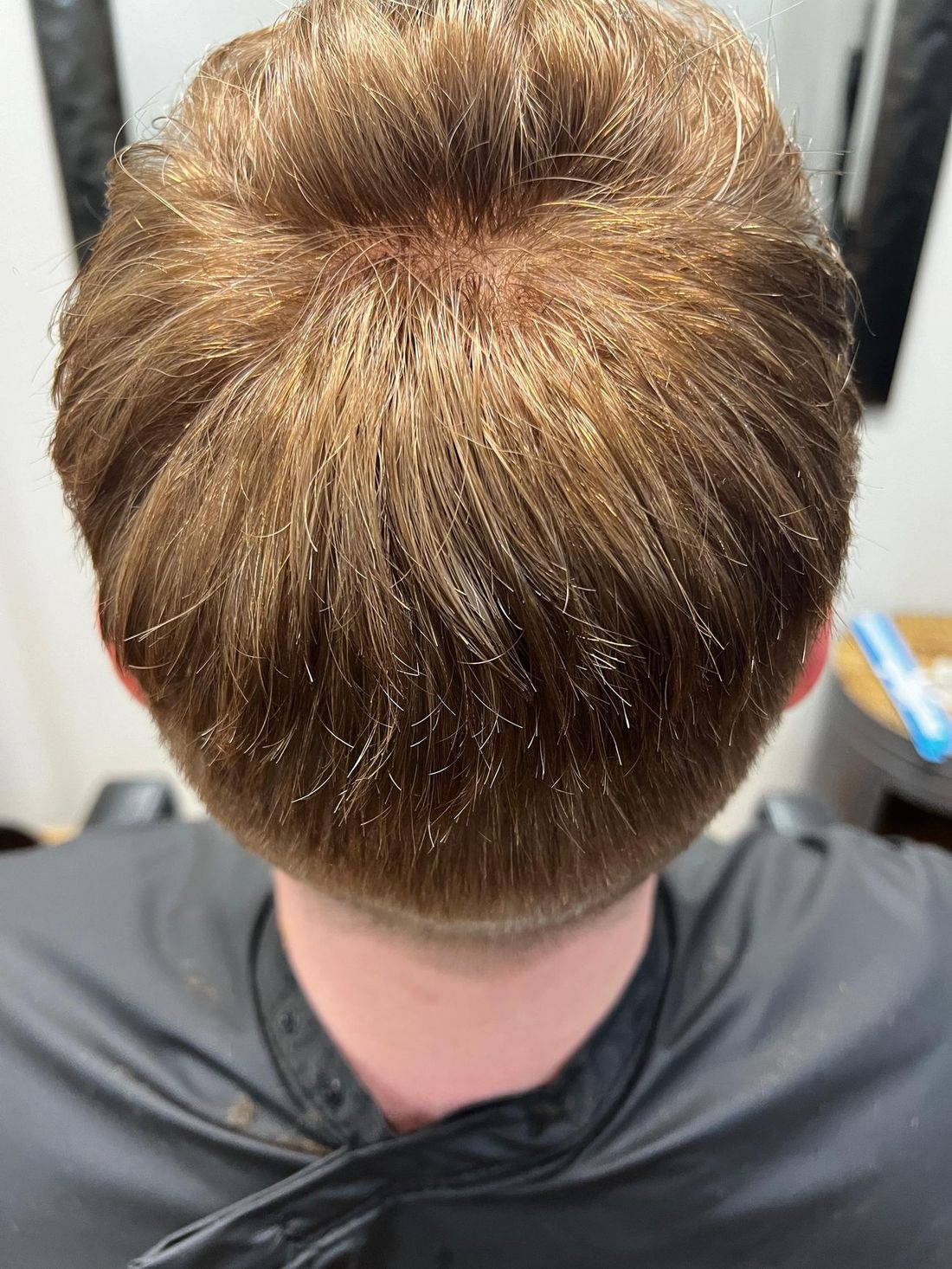 The same crown from above after a hair replacement system was fitted and blended