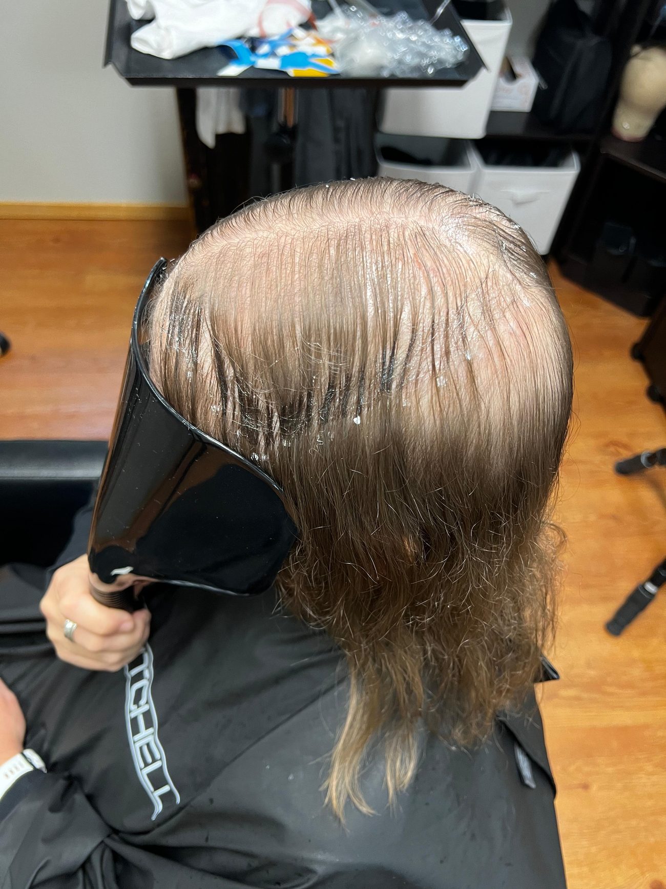 A woman’s diffuse crown thinning before a hair topper was fitted